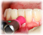 STEP３．歯周病初期治療（５）