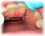 STEP３．歯周病初期治療（３）